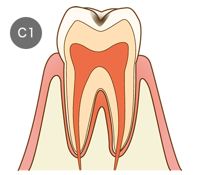 虫歯の画像1