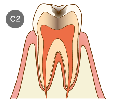 虫歯の画像2