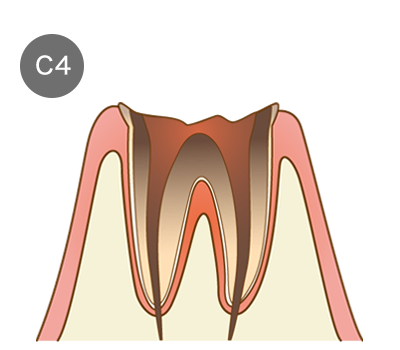 虫歯の画像4